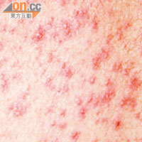 麻疹呈較密集的紅點，與皮膚敏感相似。
