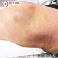 膝蓋被發現出現腫脹後兩天，大腿出現瘀黑。