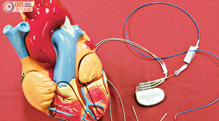 心律過慢屬心律不正的一種，嚴重者需植入心臟起搏器。