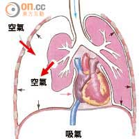 爆肺者吸氣時，空氣從缺口（紅箭咀示）走進胸腔，不論呼或吸，空氣可壓住肺及心。（受訪者提供）