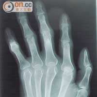 其中一名患者手部在九九年五月的X光影像。