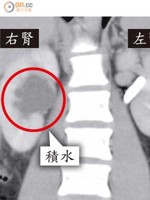 腎結石患者電腦掃描圖顯示，右邊腎臟因積水而比左邊腎腫大。（受訪者提供）