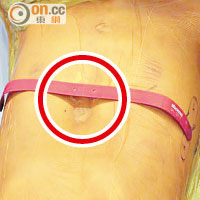 漏斗胸病童於手術前胸腔凹陷（紅圈示）。