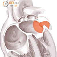 左心耳是左心房的末端，其網狀心臟肌肉組織易形成血塊。