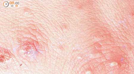 疥瘡患者皮膚出現紅疹，非常痕癢。（資料圖片）