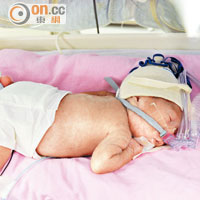 柏漮因早產致出生時只有七百克重，留院四個多月後才可回家。