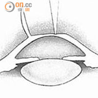 2.利用激光在角膜基層進行打磨以改變弧度。