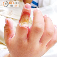 男童的右手食指韌帶被燒融。