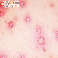 水痘是兒童常見的傳染病，本港去年就有逾萬宗個案。