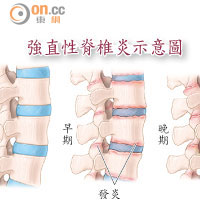 強直性脊椎炎示意圖