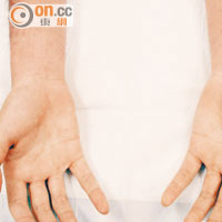 患平山病的十七歲少年，左手手掌肌肉出現萎縮，略較右手細小。