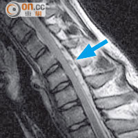 平山病患者彎低頭時，頸椎與硬脊膜會出現空隙（箭嘴示），血液流入空隙令神經線受壓。（此磁力共振影像非屬於文中提及十七歲患者。）