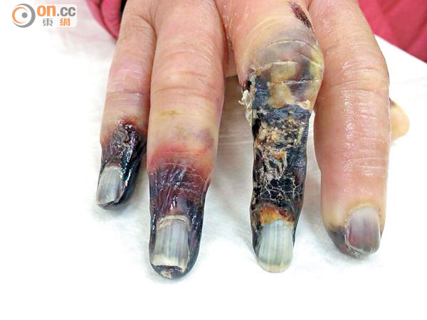 手指變藍或患硬皮症 0326-00176-068b4