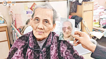 老婦跌倒受傷，送院治療後已出院，家屬展示她口腫面腫的照片。