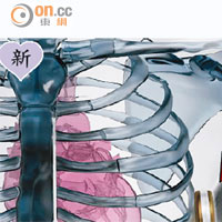 全皮下植入式心臟除顫器（箭嘴示），電極線及脈衝產生器均放在皮下。電極線包圍心臟，隔着肌肉把電流傳入心臟。