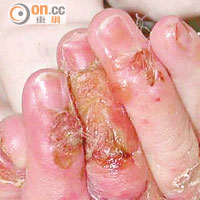 患有表皮分解性水皰症的嬰兒，手指不斷長出水泡，相當痛苦。