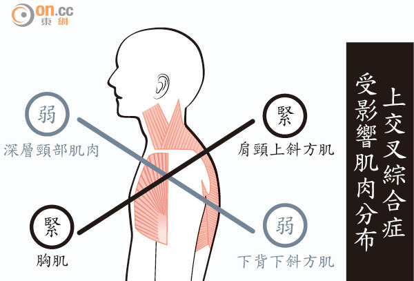 上班族坐姿差，易患電腦肩圖片6