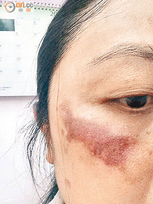 薛女士面頰接受去斑療程後，出現大片暗紅色斑。（受訪者提供）
