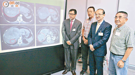 潘冬平（右二）指，溫先生（右一）雖有四個肝腫瘤，但仍可用手術切除。