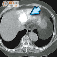乙醇消融術可將肝癌腫瘤（藍箭嘴）殺死，圖中病人的腫瘤體積縮小九成（紅箭嘴）。