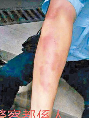 facebook流傳一張警員手部傷痕纍纍的照片。（互聯網圖片）