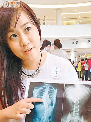 朱珏欣所指的X光圖正是十五歲女生的「S形」腰椎。