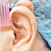 治療前耳骨出現疤痕增生，經冷凍治療後耳朵外觀回復正常。（受訪者提供）