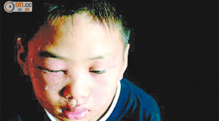 過去湖北省過百名居民因接觸隱翅蟲毒液而皮膚潰爛。