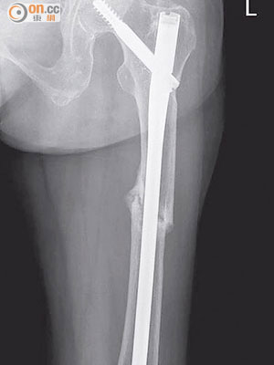 老婦的左端股骨骨折由內向外裂開，與一般跌傷有異，估計因長期服食藥物致非典型骨折。