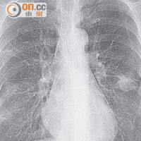 X光片顯示女病人的肺部「花咗」。
