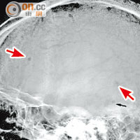 掃描片顯示頭顱有異常裂開（箭嘴示）。