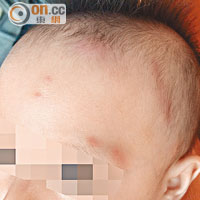有孩童頭部被蚊子叮至多處紅腫。