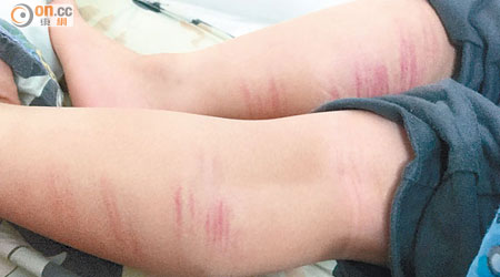 有家長日前在網上上載五張有十多條「藤條痕」的男童雙腿照片，引起網民熱議。（資料圖片）