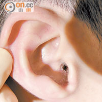 男病人的耳朵皮膚持續有紅腫情況。