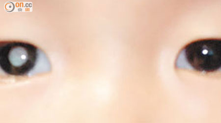 大部分小兒眼疾都會有「白瞳症」徵狀，在相片中可清楚見到眼底反射出白色。（受訪者提供）