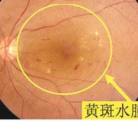 DME患者出現黃斑水腫（黃圈），影響中央視力。
