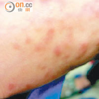 確診患皮下環狀肉芽腫的女童左腳背出現大量丘疹。