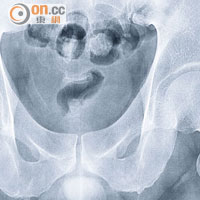 出事前<br>由X光片可見，阿明出事前，股骨頸沒有明顯裂痕。