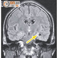 磁力共振圖顯示患者左邊顳葉海馬體（箭嘴示）硬化。（屯門醫院提供）