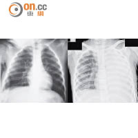 肺炎黴漿菌引致的肺炎可嚴重至「成個肺花晒」（左為正常肺部，右白色部分代表發炎）。（受訪者提供）