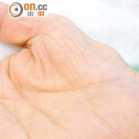 腕管綜合症嚴重患者的拇指下方大魚際肌出現萎縮，影響拇指活動能力。
