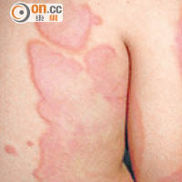 風疹典型病徵是皮膚浮現腫脹的疹塊。（受訪者提供）