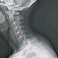 十六歲女 <br>十六歲女孩「短訊頸」問題嚴重，脊椎嚴重彎曲。（互聯網圖片）