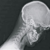 變形頸椎（互聯網圖片）