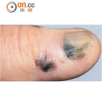 黑色素瘤可在隱蔽甲床出現，容易被誤作瘀傷。