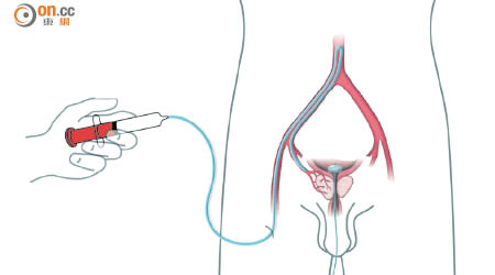 新手術處理方法<br>1.微導管經由大腿動脈延伸至盆腔血管