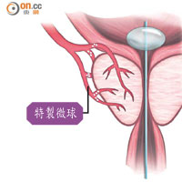 2.直徑約一百至三百微米的特製微球，透過微導管注入前列腺動脈特製微球<br>3.微球堵塞動脈後，相關腺狀組織缺血性壞死及萎縮