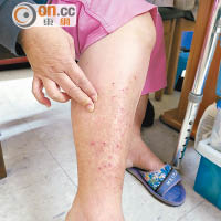 張先生妻子小腿被蚊叮至體無完膚。