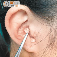 在耳朵對應穴位貼藥，刺激穴道，可達減肥效果。