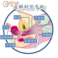 圖解刮宮手術 <br>若子宮留有胚胎組織殘留物，醫生可用內窺鏡並利用手術鉗或吸管取出。